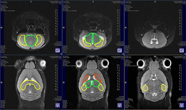 Figure 4 T2 weighted images with important targets for deep brain fMRI study highlighted by color: yellow=hippocampus; green= thalamus; orange=basal ganglia.' 